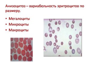 Анизоцитоз у ребенка