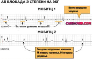 АВ блокада 2 степени