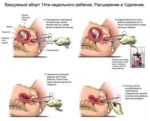 Аборт на 11 неделе