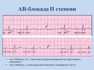 АВ блокада 2 степени