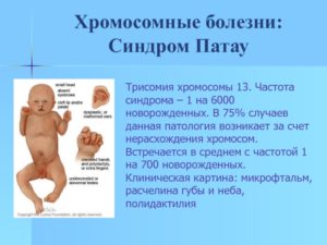 Трисомия по 22 хромосоме у эмбриона