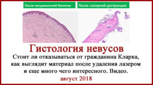Гистология после удаления невуса