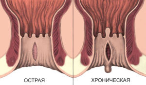 После секса появляется трещина