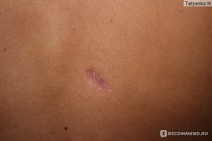Шрам после удаления родинки