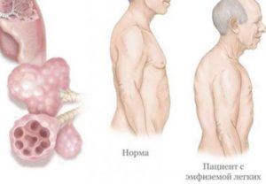 Сколько живут с эмфиземой легких
