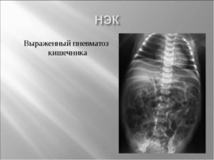 Выраженный пневматоз