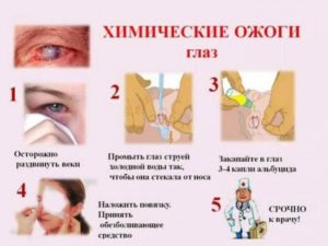 Химический ожог глаз