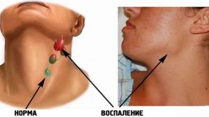 Комок в горле. Увеличены лимфоузлы