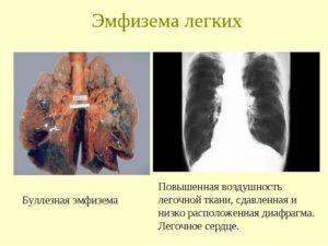 Сколько живут с эмфиземой легких