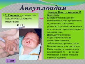 Трисомия по 22 хромосоме у эмбриона