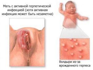 Гнойник на малой половой губе