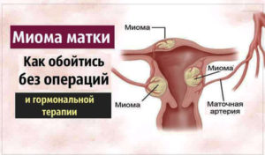 Ок при миоме матки