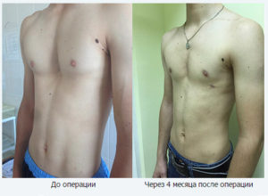 Деформация ребер