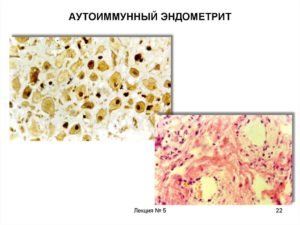 Аутоиммунный эндометрит