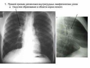 Образование в корне левого легкого на рентген