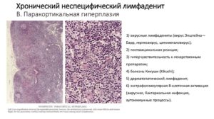 Неспецифический лимфаденит