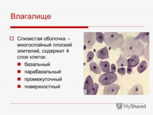 U - Эпителий плоский поверхностного слоя 10-15 в п/зр