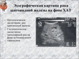 Определение рака щитовидной железы по УЗИ