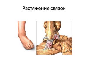 Как определить было просто растяжение или разрыв связок