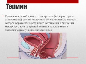 Ректоцеле 1-2 ст