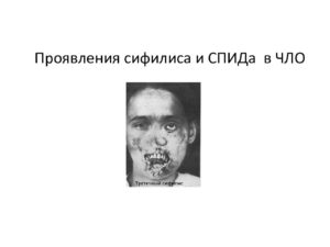 Симптомы сифилиса или вич