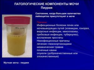 После лечения холецистита лейкоциты в моче 500