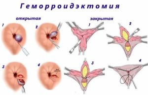 Удалила анальную бахромку
