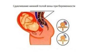 Венозный поток во время беременности