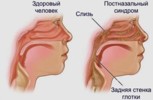 Ком в горле, слизь из носа стекает по горлу