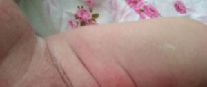 Очень сильное покраснение в паху у грудничка