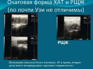 Определение рака щитовидной железы по УЗИ