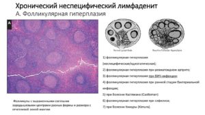 Неспецифический лимфаденит