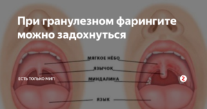 Гранулезный фарингит у ребенка