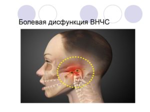 Дисфункция ВНЧС