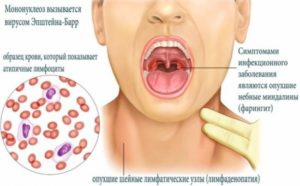 Повторный мононуклеоз?