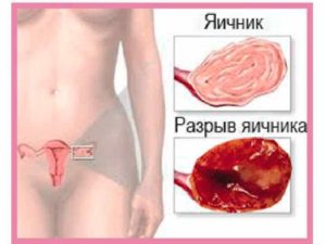Левый яичник прощупывается сильнее чем правый