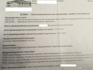 Гистология после удаления невуса