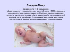 Трисомия по 22 хромосоме у эмбриона