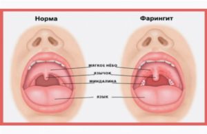 Постоянный сухой кашель и красное горло с оттеком