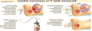 Аборт без разрешения родителей