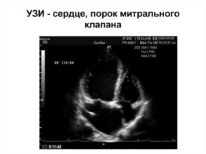 УЗИ. Уменьшение размера сердца