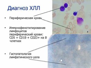Расшифровка анализа иммунофенотипирование периферической крови