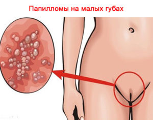 Большой прыщик около клитора