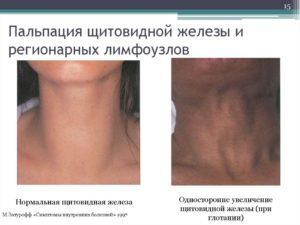 Щитовидная железа и увеличение лимфоузлов