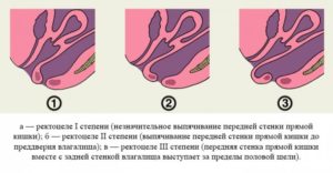Ректоцеле 1-2 ст