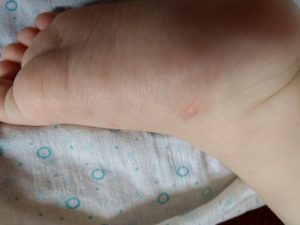 Твердые прыщики у ребенка на руке