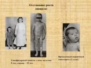 Отставание в росте