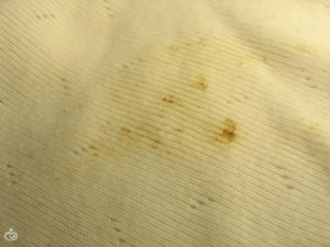 Срыгивания с коричневыми прожилками