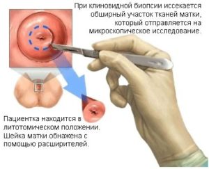 Задержка 15 дней после биопсии шейки матки