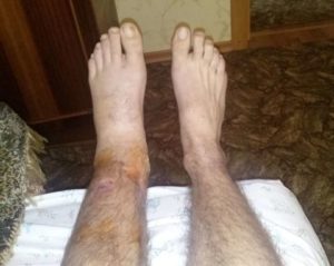 После перелома одна нога тоньше другой